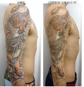 大きいタトゥー、マルチカラータトゥーこそピコレーザー（エンライトン）を検討してください。