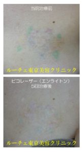 他院修正　他院でとりきれなかったタトゥーも任せてください