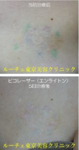 他院修正のカラータトゥー