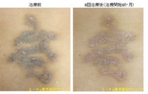 腰の他院修正例