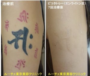 タトゥー除去ピコレーザー、7回、腕、黒、赤、とれた