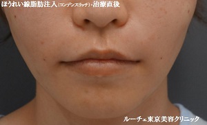 ほうれい線脂肪注入 コンデンスリッチ 美容外科 皮膚科 婦人科形成のルーチェクリニック