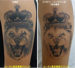 タトゥー除去ピコレーザー、1回、腕、黒