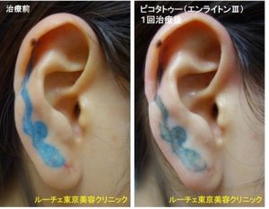タトゥー除去ピコレーザー、1回、耳、青、赤