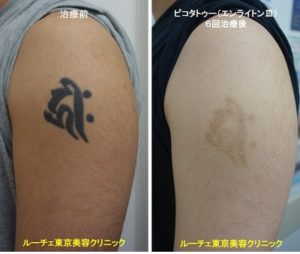 タトゥー除去ピコレーザー、6回、腕、黒、とれた