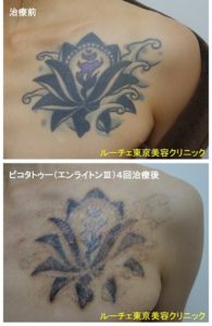 タトゥー除去ピコレーザー、4回、胸、黒、紫
