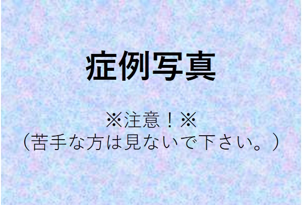 小陰唇縮小術症例写真　立った状態の写真