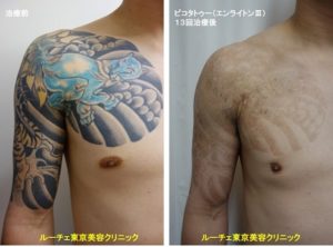 タトゥー除去ピコレーザー、13回、胸～腕、黒、水色、赤、黄色、オレンジ