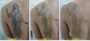 タトゥー除去ピコレーザー、2回、背中、黒、経過