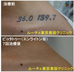 タトゥー除去ピコレーザー、7回、肩、黒、とれた