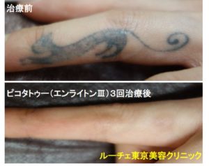 タトゥー除去ピコレーザー、3回、指、黒、とれた
