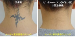 タトゥー除去ピコレーザー、2回、項、黒、とれた