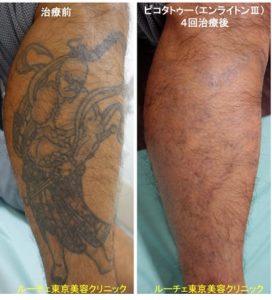 タトゥー除去ピコレーザー、4回、足、黒、とれた
