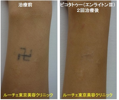 タトゥー除去ピコレーザー、2回、腕、黒、とれた