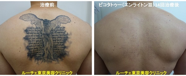 タトゥー除去ピコレーザー、14回、背中、黒、とれた