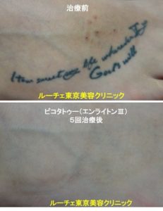 タトゥー除去ピコレーザー、5回、足、黒、とれた
