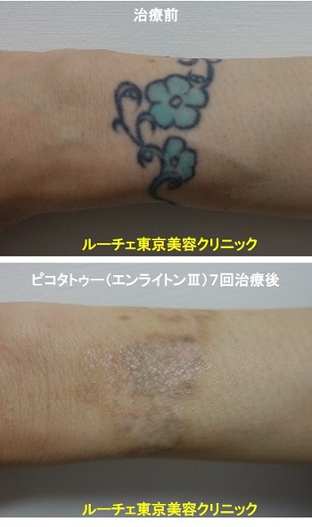 タトゥー除去ピコレーザー、腕、７回、黒、水色、とれた