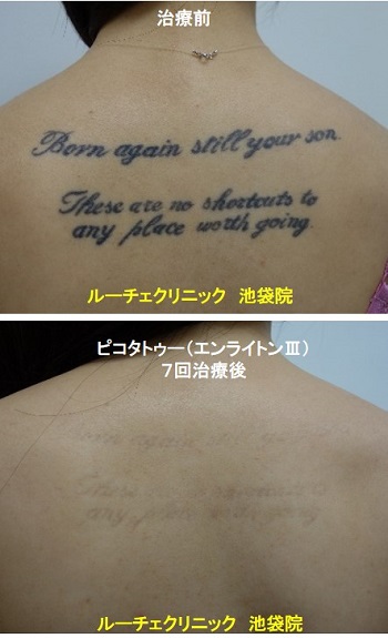 タトゥー除去ピコレーザー、背中、７回、黒