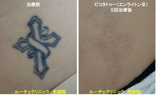 タトゥー除去ピコレーザー、顔、4回、黒、とれた