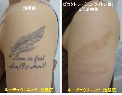 タトゥー除去ピコレーザー、腕、5回、黒、とれた