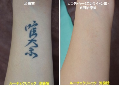 タトゥー除去ピコレーザー、腕、6回、黒、とれた