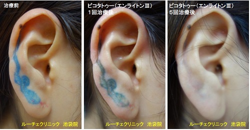 タトゥー除去ピコレーザー、耳、5回、青、とれた、経過