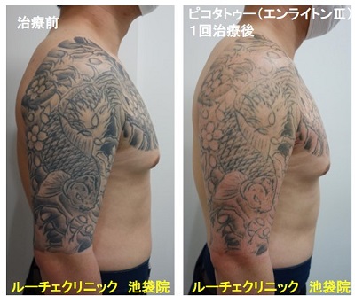 タトゥー除去ピコレーザー、腕、1回、黒