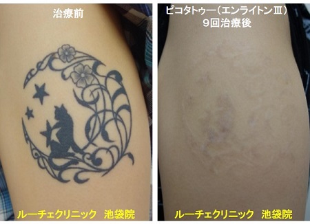 タトゥー除去ピコレーザー、腕、9回、黒、とれた