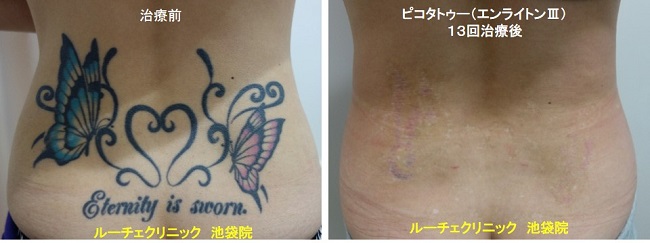 タトゥー除去ピコレーザー、腰、13回、青、赤、黒、とれた