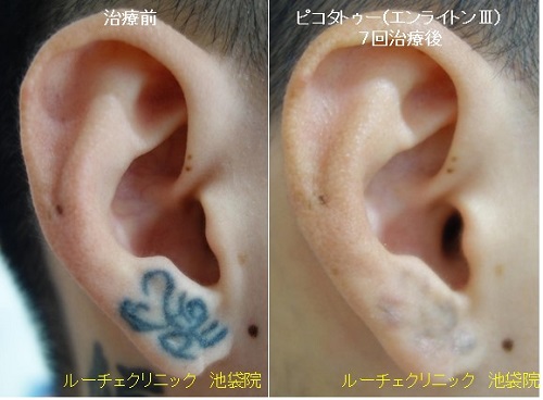 タトゥー除去ピコレーザー、耳、7回、黒