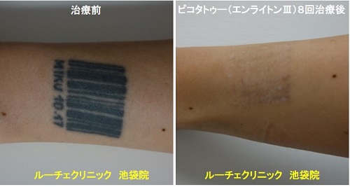 タトゥー除去ピコレーザー、手首、8回、黒、とれた