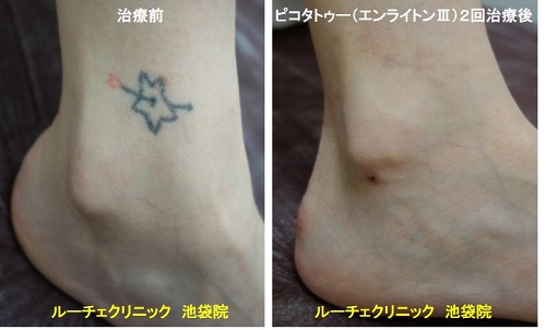 タトゥー除去ピコレーザー、腰、１回、黒、とれた