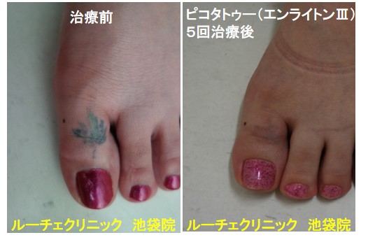 タトゥー除去ピコレーザー、足指、5回、黒、緑