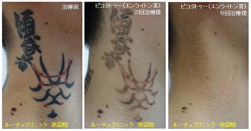 タトゥー除去ピコレーザー、首、6回、黒、赤、とれた