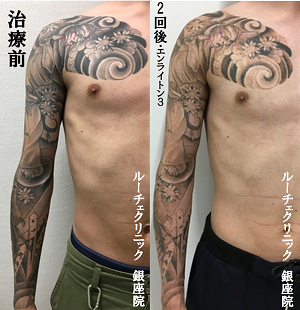 タトゥー除去ピコレザー、2回、腕、黒