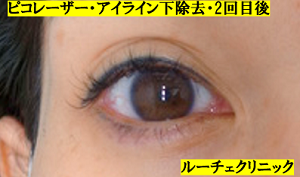 タトゥー除去ピコレーザー、アイライン下、2回、黒