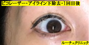 タトゥー除去ピコレーザー、アイライン下、2回、黒