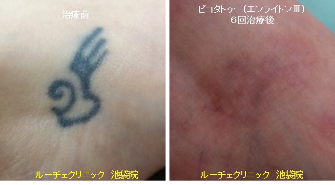 タトゥー除去ピコレーザー、足甲、6回、黒、とれた