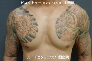 タトゥー除去、ピコレーザー、胸、1回、黒、赤、緑、黄色