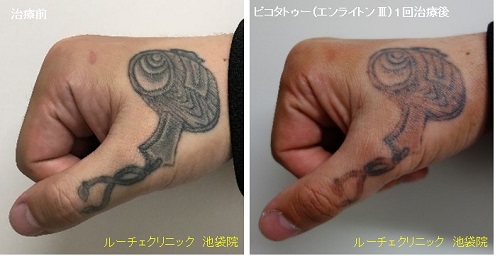 タトゥー除去ピコレーザー、手、1回、黒