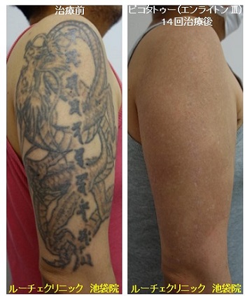 タトゥー除去ピコレーザー、14回、腕、黒