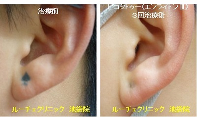 タトゥー除去ピコレーザー、3回、耳、黒