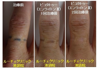 タトゥー除去ピコレーザー、2回、指、黒