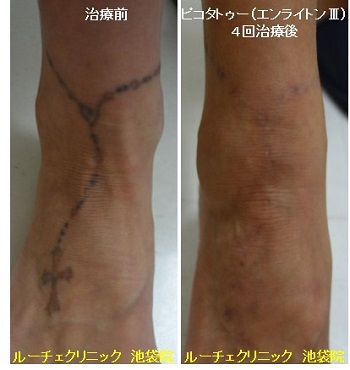 タトゥー除去ピコレーザー、足、４回、黒、とれた