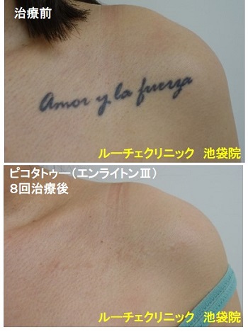 タトゥー除去ピコレーザー、胸、８回、黒、とれた