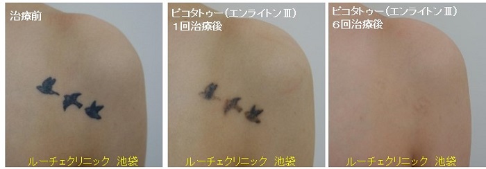 タトゥー除去ピコレーザー、6回、胸、黒、とれた、経過