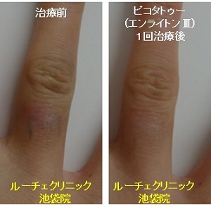 タトゥー除去ピコレーザー、1回、指、黒、とれた