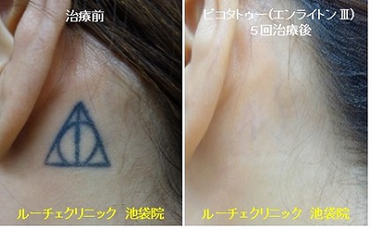 タトゥー除去ピコレーザー、5回、項、黒、とれた
