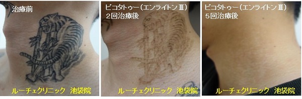 タトゥー除去ピコレーザー、5回、首、黒、とれた、経過