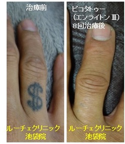 タトゥー除去ピコレーザー、8回、指、黒、とれた